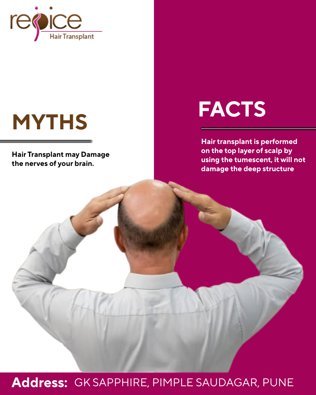 Thinking About Hair Transplant? What Pune Patients Should Know First